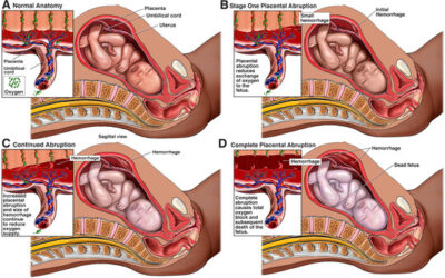 Birth Injury Claims: Obstetric Emergencies