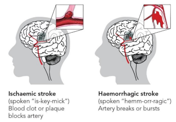 Medical Negligence: Claims for Stroke
